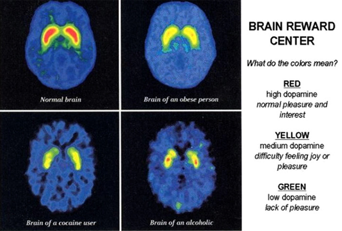 Image result for Brain scan of a glutton